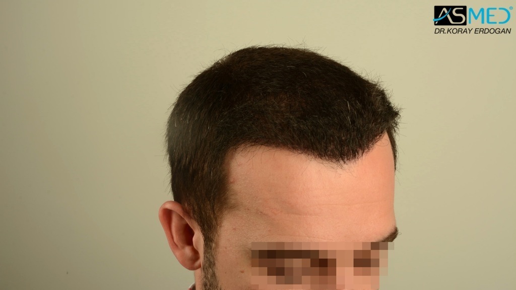Norwood3v 3850-grafts-FUE file_zpsf436087d