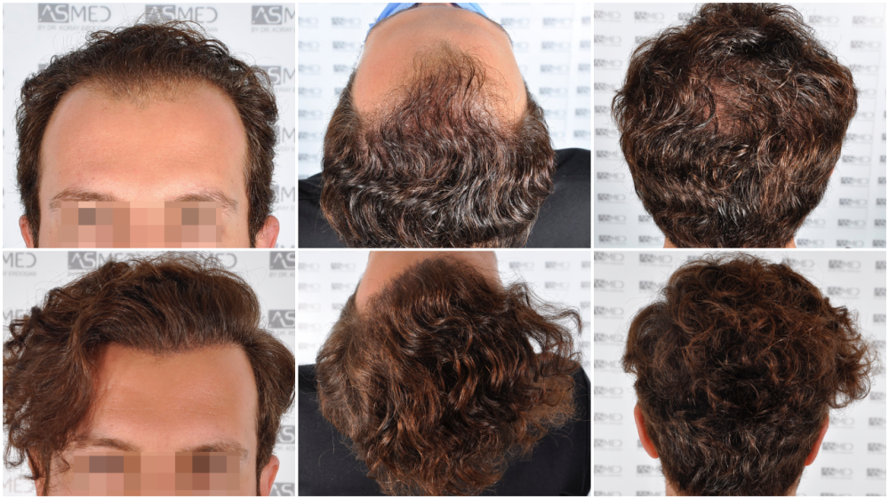 How Many Hair Grafts Do I Need  Norwood Scale Hair Transplant