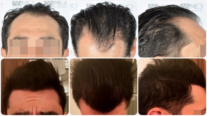 Norwood 4 Hair Transplantation Results | Asmed Hair Transplant Norwood 4 Hair Transplantation Results | Asmed Hair Transplant