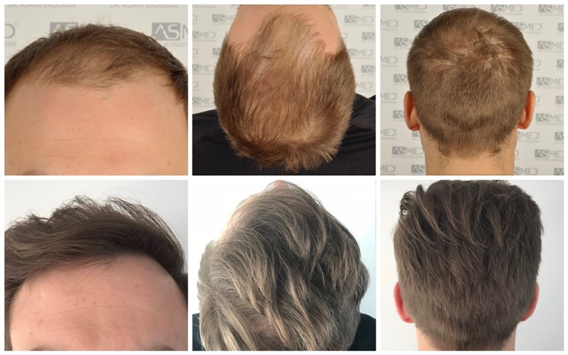 Norwood 4 Hair Transplantation Results | Asmed Hair Transplant Norwood 4 Hair Transplantation Results | Asmed Hair Transplant