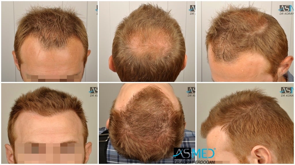 Norwood 4 Hair Transplantation Results | Asmed Hair Transplant Norwood 4 Hair Transplantation Results | Asmed Hair Transplant