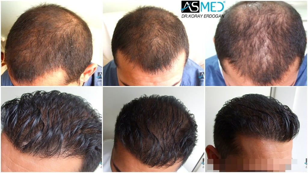 A Complete Guide about Hair transplant Cost 2000 Grafts in Pakistan