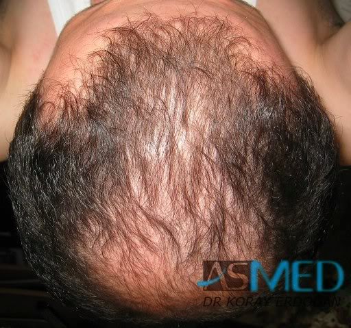 Norwood5 2250-grafts-FUE 3251960c