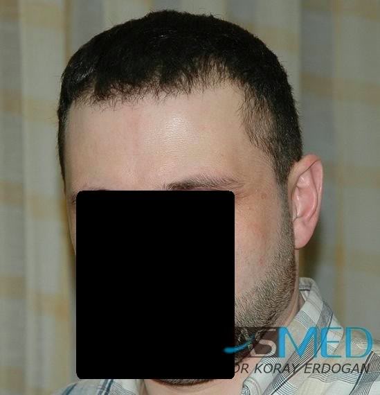 Norwood5 2250-grafts-FUE 3e2e8f04