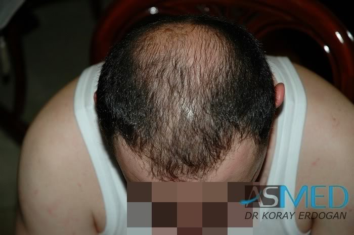 Norwood5 2250-grafts-FUE 41b6b8b3