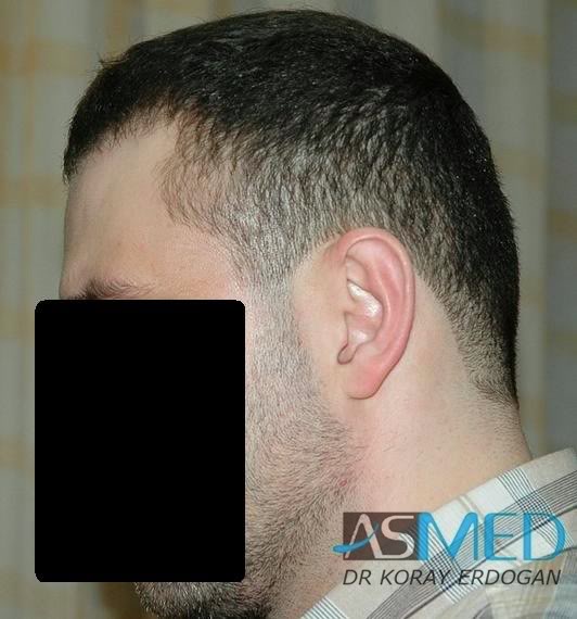 Norwood5 2250-grafts-FUE 5183229d