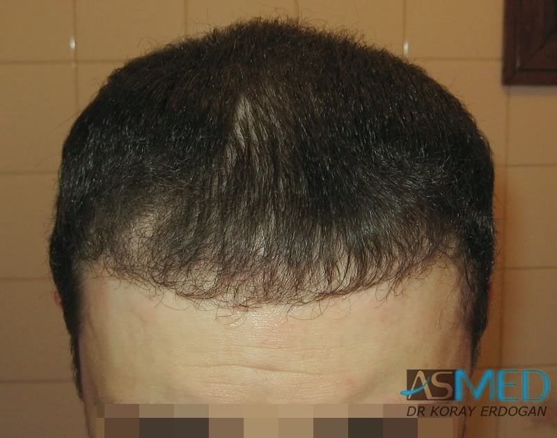 Norwood5 2250-grafts-FUE 5321c9cf