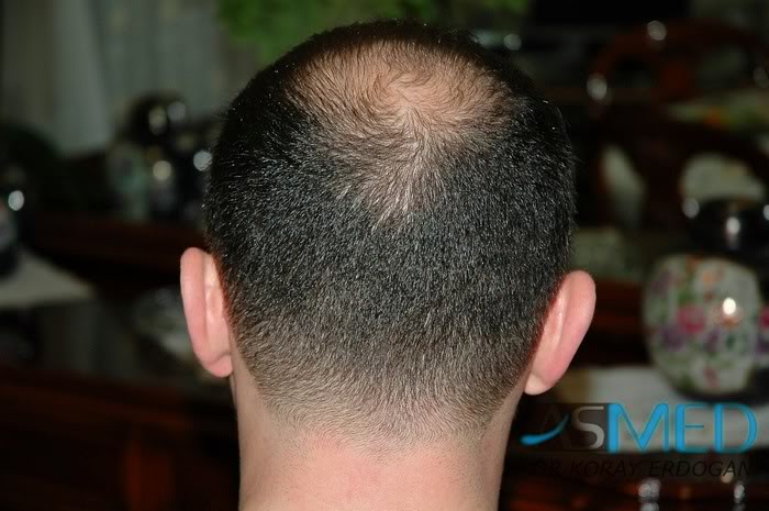 Norwood5 2250-grafts-FUE 5889fb0f