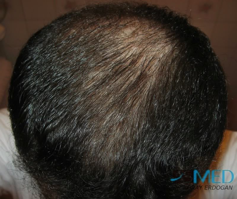 Norwood5 2250-grafts-FUE 69c63cfb