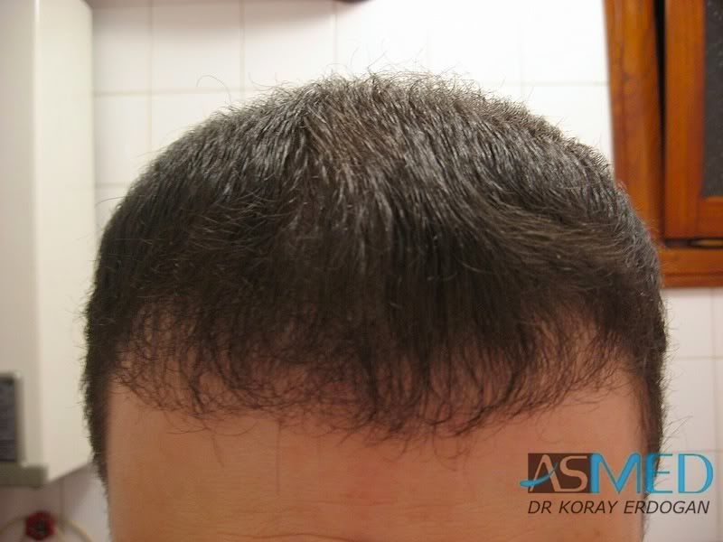 Norwood5 2250-grafts-FUE 8644a148