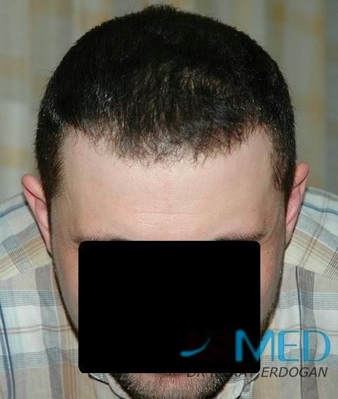 Norwood5 2250-grafts-FUE 8665bdc8