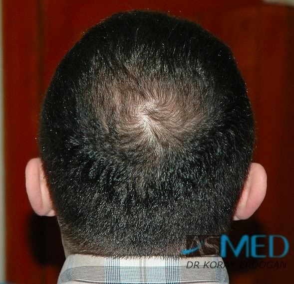 Norwood5 2250-grafts-FUE 99bb72d4