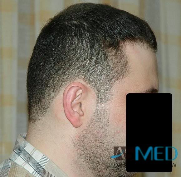 Norwood5 2250-grafts-FUE a51af7f0