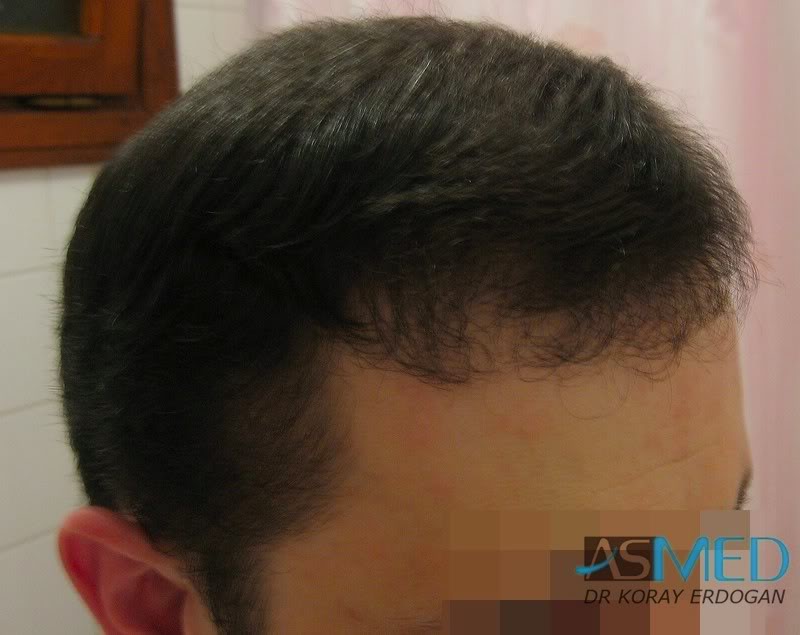 Norwood5 2250-grafts-FUE c3216205