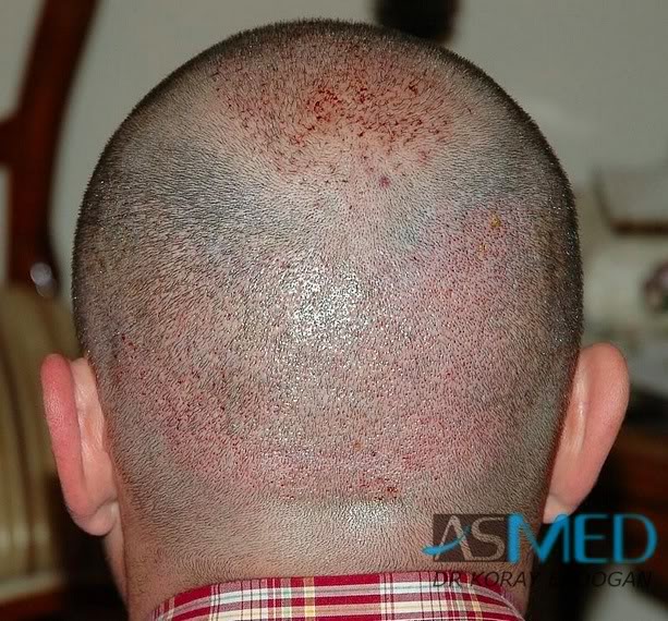 Norwood5 2250-grafts-FUE d5f26923