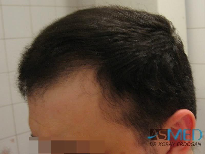 Norwood5 2250-grafts-FUE d7edb0ec