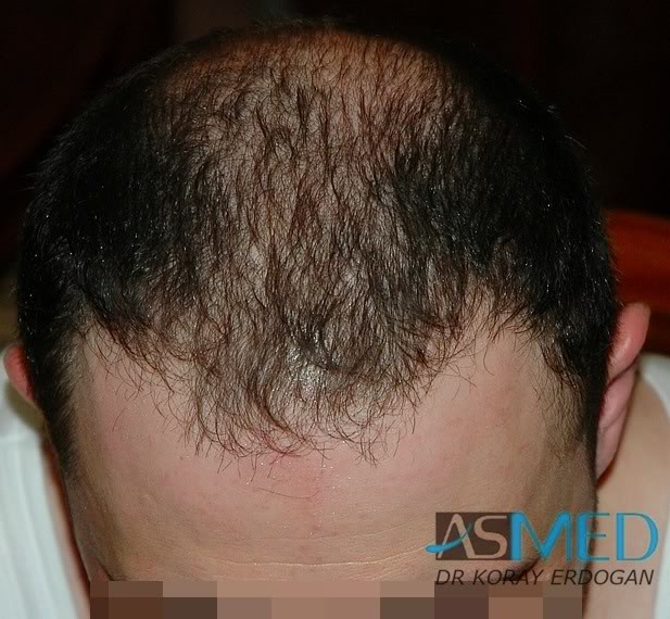 Norwood5 2250-grafts-FUE e28bec86
