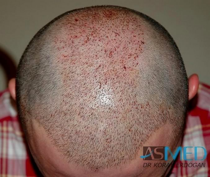Norwood5 2250-grafts-FUE f45e22af