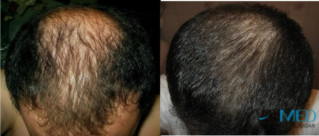 Norwood5 2250-grafts-FUE fe3ff61b
