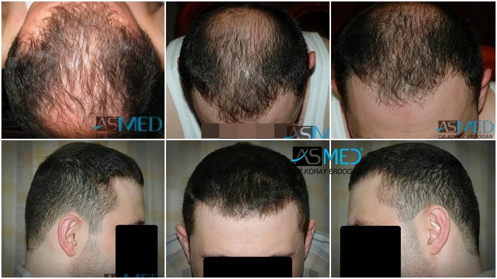 2250-grafts-FUE