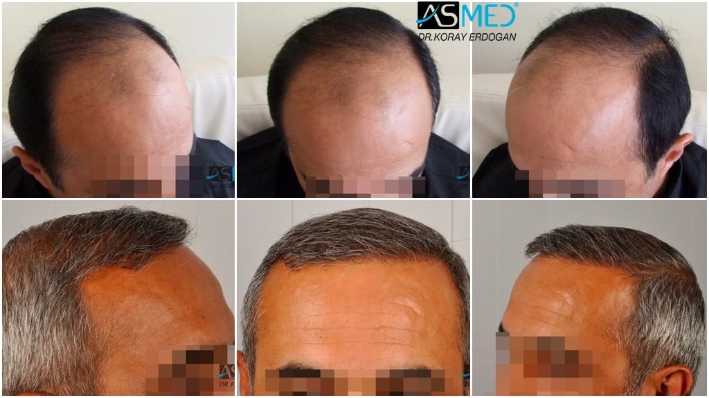 2400 Grafts Fue Norwood 6 Ergebnisse Der Asmed Haartransplantation