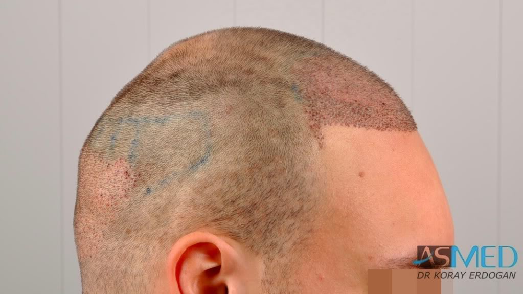 Norwood5 2400-grafts-FUE file-10