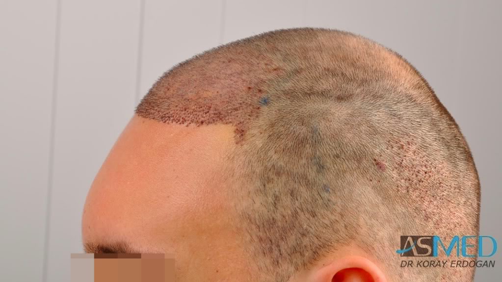 Norwood5 2400-grafts-FUE file-11