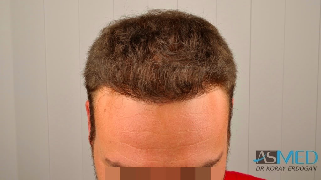 Norwood5 2400-grafts-FUE file-14