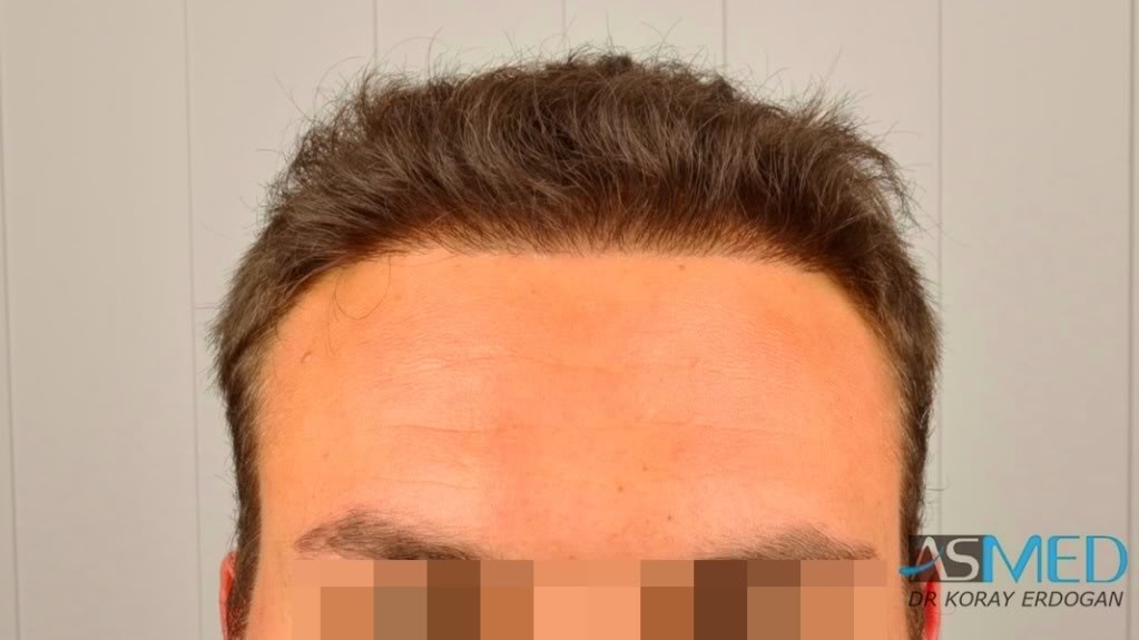 Norwood5 2400-grafts-FUE file-15
