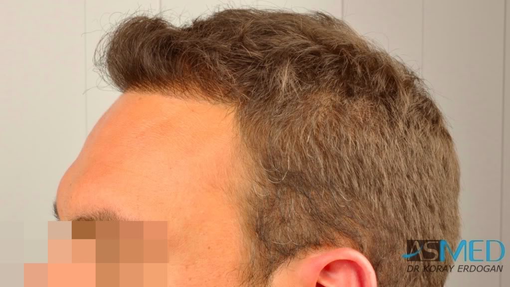 Norwood5 2400-grafts-FUE file-16