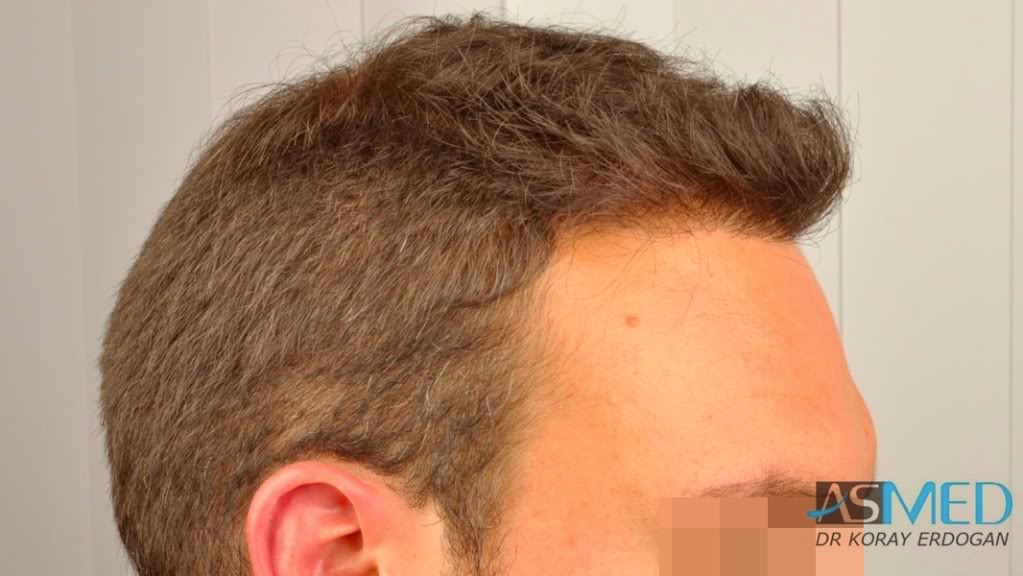 Norwood5 2400-grafts-FUE file-17