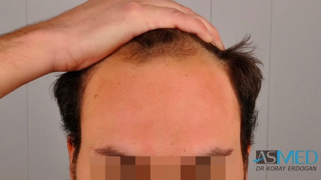 Norwood5 2400-grafts-FUE file-2