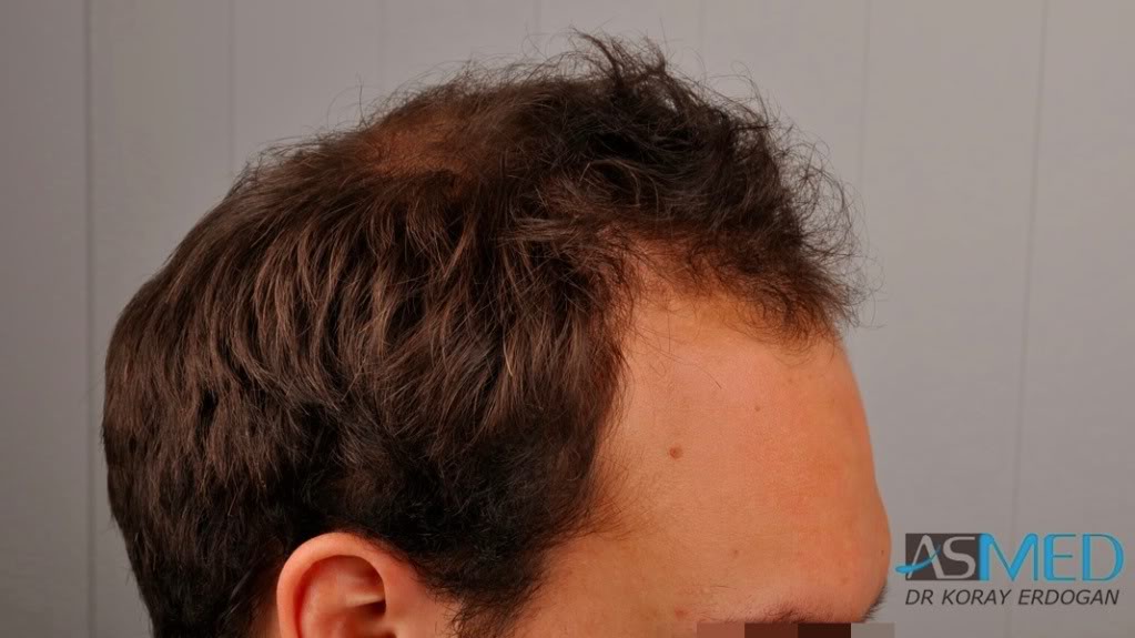 Norwood5 2400-grafts-FUE file-3