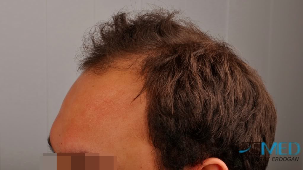 Norwood5 2400-grafts-FUE file-4