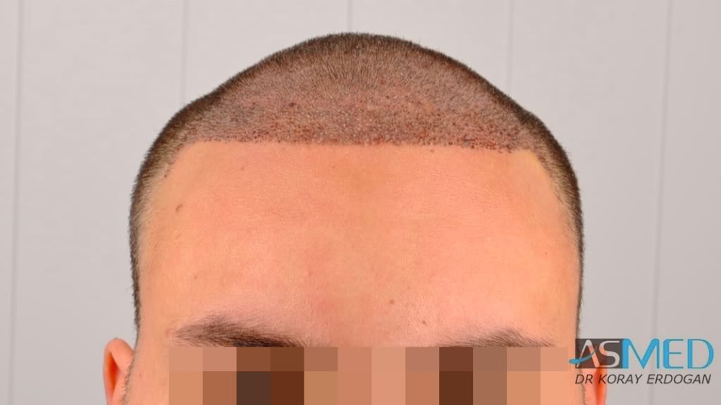 Norwood5 2400-grafts-FUE file-8