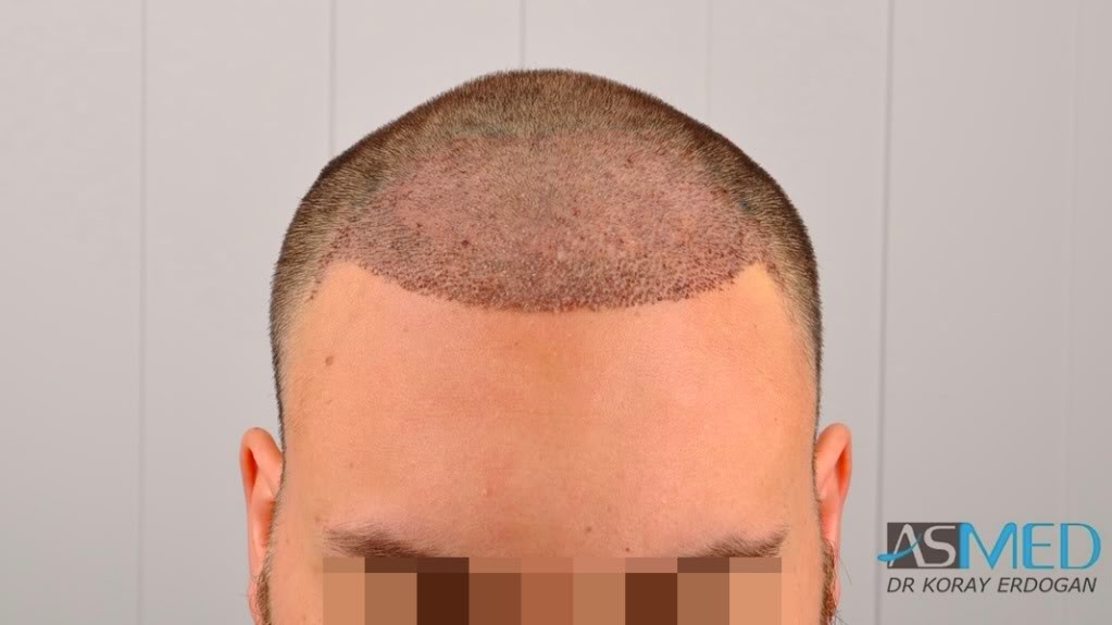 Norwood5 2400-grafts-FUE file-9