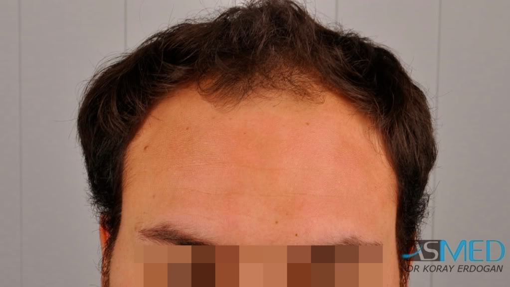 Norwood5 2400-grafts-FUE file