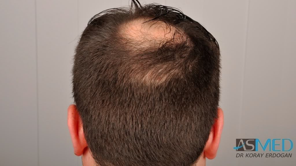 Norwood5 2600-grafts-FUE 04d5be6a