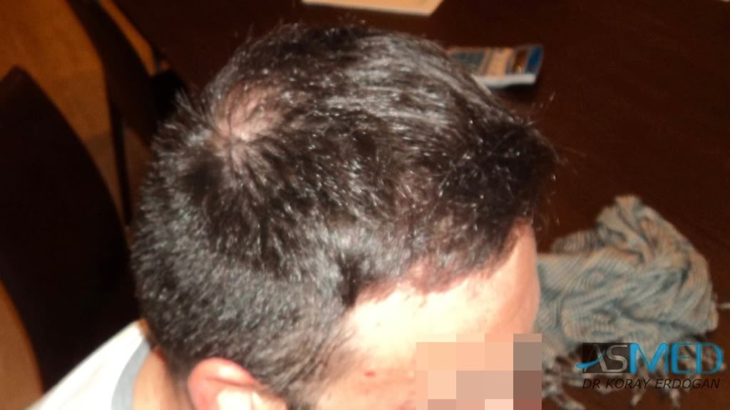 Norwood5 2600-grafts-FUE 37b10073