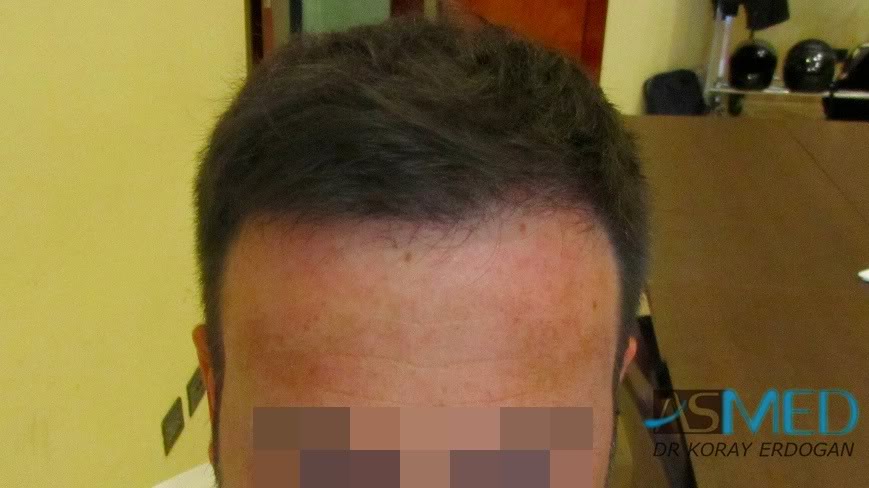 Norwood5 2600-grafts-FUE 544635de
