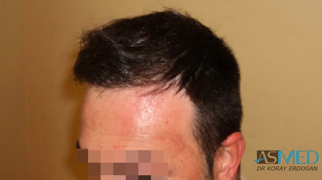 Norwood5 2600-grafts-FUE 89bafb2e