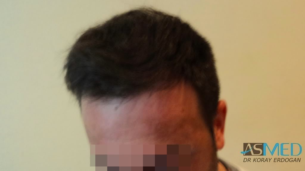 Norwood5 2600-grafts-FUE 89f56fc2