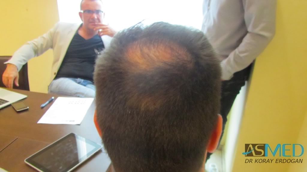 Norwood5 2600-grafts-FUE 94730131