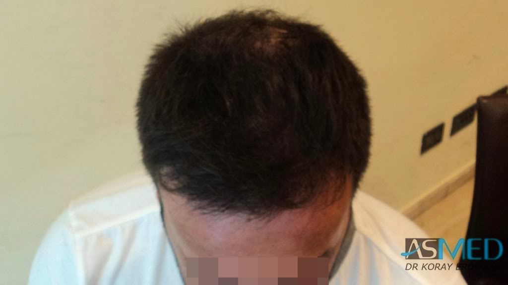 Norwood5 2600-grafts-FUE 95fbd356