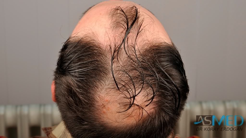 Norwood5 2600-grafts-FUE a4cb9153