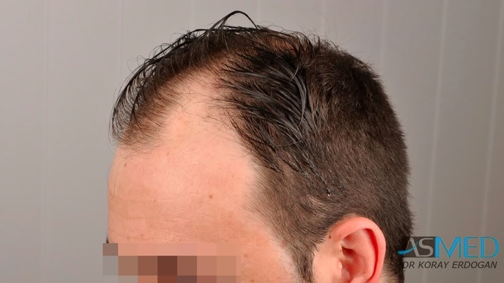 Norwood5 2600-grafts-FUE b7026282