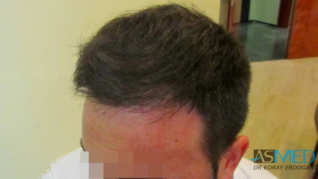 Norwood5 2600-grafts-FUE bbf394ec