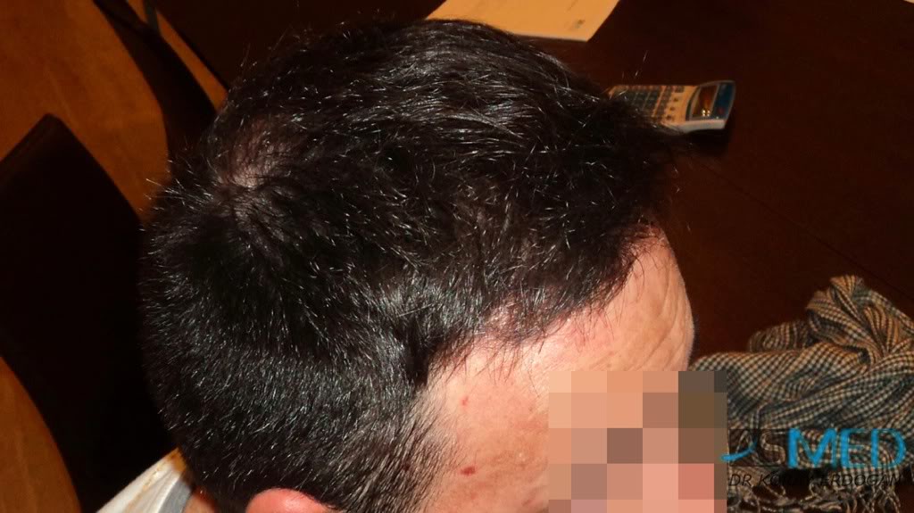 Norwood5 2600-grafts-FUE d71eab90