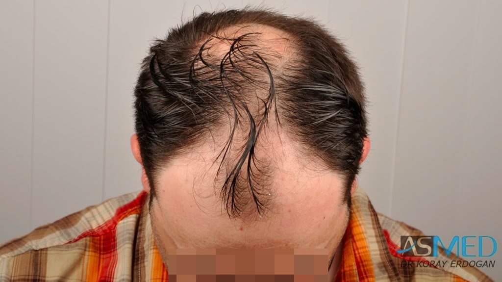 Norwood5 2600-grafts-FUE fd57776d