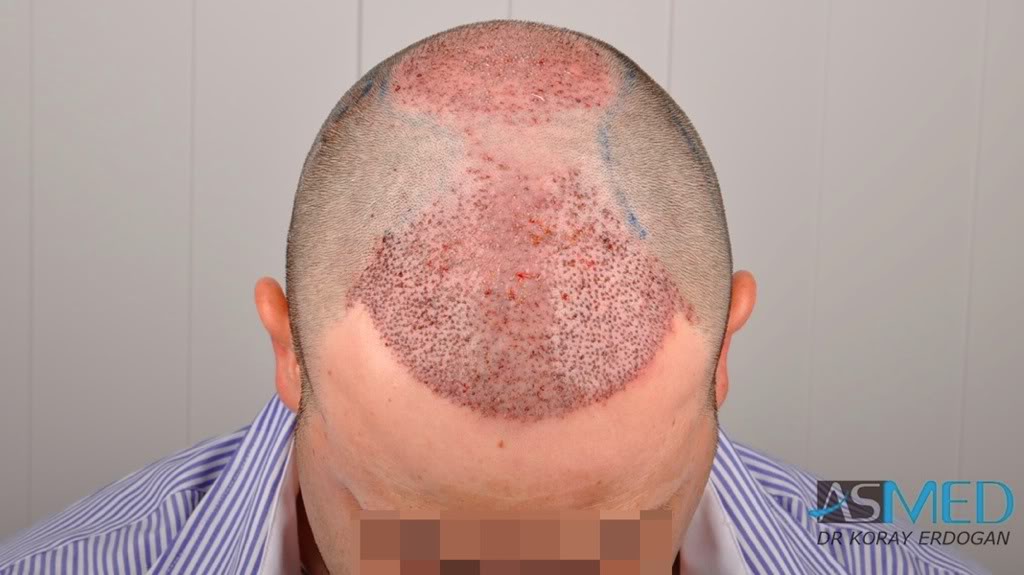 Norwood5 2600-grafts-FUE ffabd239